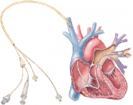 Heart Catheterization 