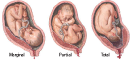 Placenta Previa 