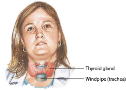 GRAVES’ DISEASE 