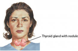 THYROID NODULE 