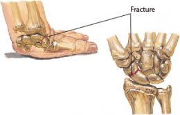 Wrist Fractures