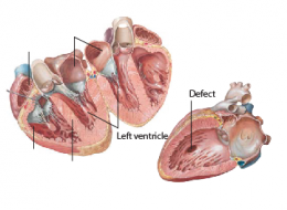 Ventricular Septal Defect (VSDs)