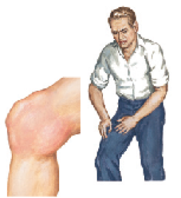 Knee Swelling
