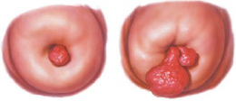 Cervical Polyps 