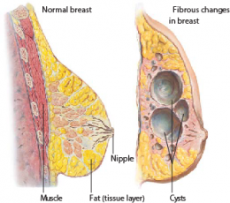 Fibrocystic Breast Changes