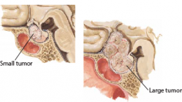 Pituitary Adenomas 