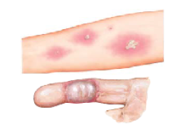Bites and Stings 