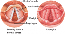  Laryngitis