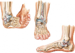 Ankle Sprains 