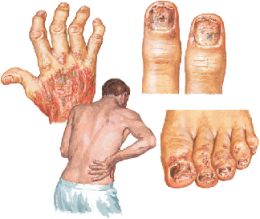 Psoriatic Arthritis 