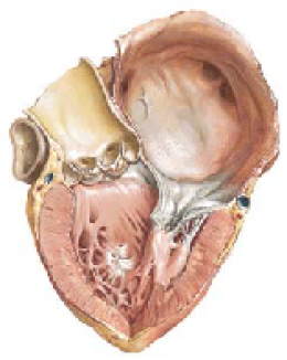 Mitral stenosis