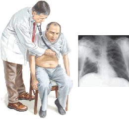 aspiration pneumonia