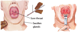 Epstein-Barr Virus (EBV) Infection 
