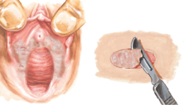Lichen Sclerosus