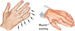 Cubital Tunnel Syndrome 
