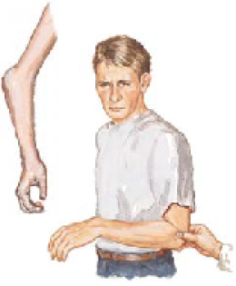 Elbow Dislocation 
