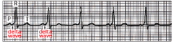 Wolff-Parkinson-White (WPW) syndrome