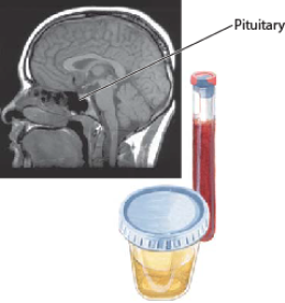 Pituitary Adenomas 