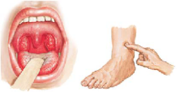 Mitral stenosis