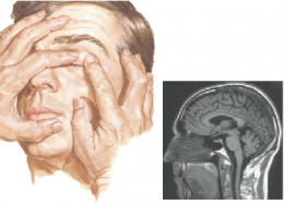 Cavernous Sinus Thrombosis 