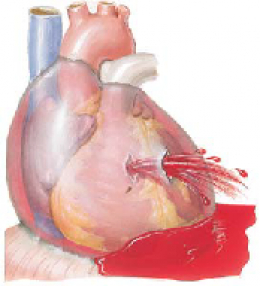  Cardiac Tamponade