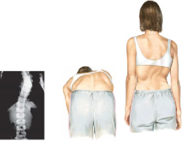 Scoliosis 