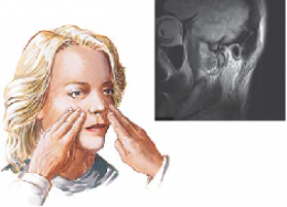 Temporomandibular Joint Syndrome
