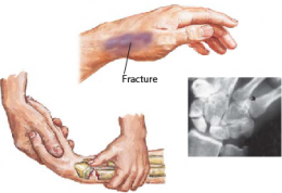 Wrist Fractures