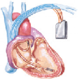 Supraventricular Tachycardia