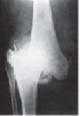 Charcot Joint