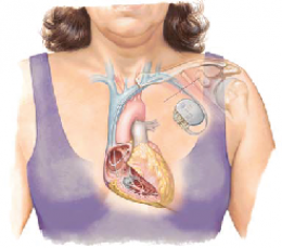 โรคกล้ามเนื้อหัวใจหนาผิดปกติ