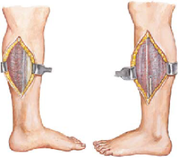 COMPARTMENT SYNDROME 