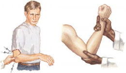 Tennis Elbow 