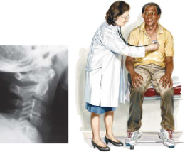 Torticollis 