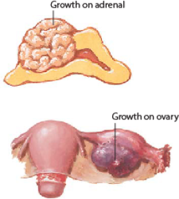 Hirsutism 