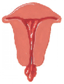 Vaginal Cancer 
