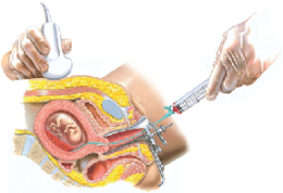 Neurofibromatosis Type 2