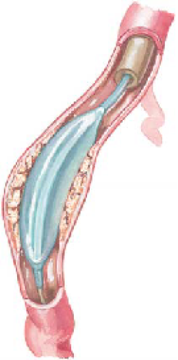 KAWASAKI DISEASE 