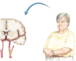 Carotid Stenosis 