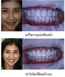 วีเนียร์ ทำฟันสวยงาม แปะฟัน