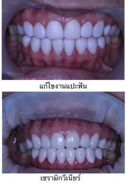 วีเนียร์ ทำฟันสวยงาม แปะฟัน