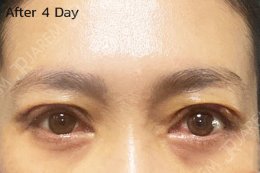 รักษาอาการตาปรือ หน้าเหนื่อย หน้าง่วง จากกล้ามเนื้อตาอ่อนแรง