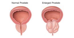 'Benign Prostate Hyperplasia', a male health problem that can be solved.