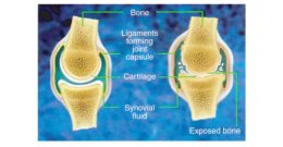 Solve the deep root cause of osteoarthritis with glucosamine sulfate.
