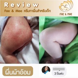 Diaper Dermatitis 