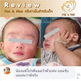 ผื่นภูมิแพ้ผิวหนังในเด็กก่อนวัย 1 ปี