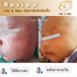 ผื่นภูมิแพ้ผิวหนังในเด็กก่อนวัย 1 ปี