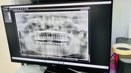 ติดตั้งเครื่องเอ็กซ์เรย์ X-ray 2D Double Sensor ณ Yimwan Dental Clinic จังหวัดขอนแก่น