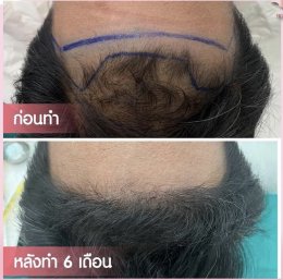 ปลูกผมถาวร FUE (Follicular Unit Extraction)