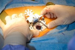 الجراحة طفيفة التوغل للعمود الفقري من خلال شقوق جراحية صغيرة عن طريق منظار